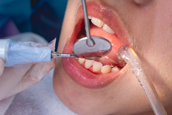 How Often Should You Get A Teeth Cleaning?